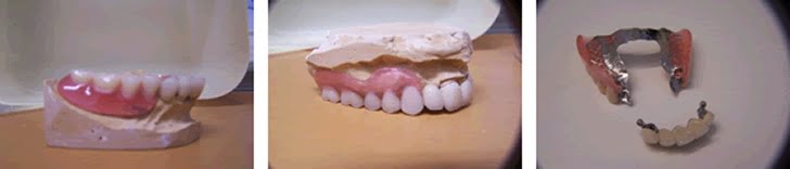 Prótesis mixta