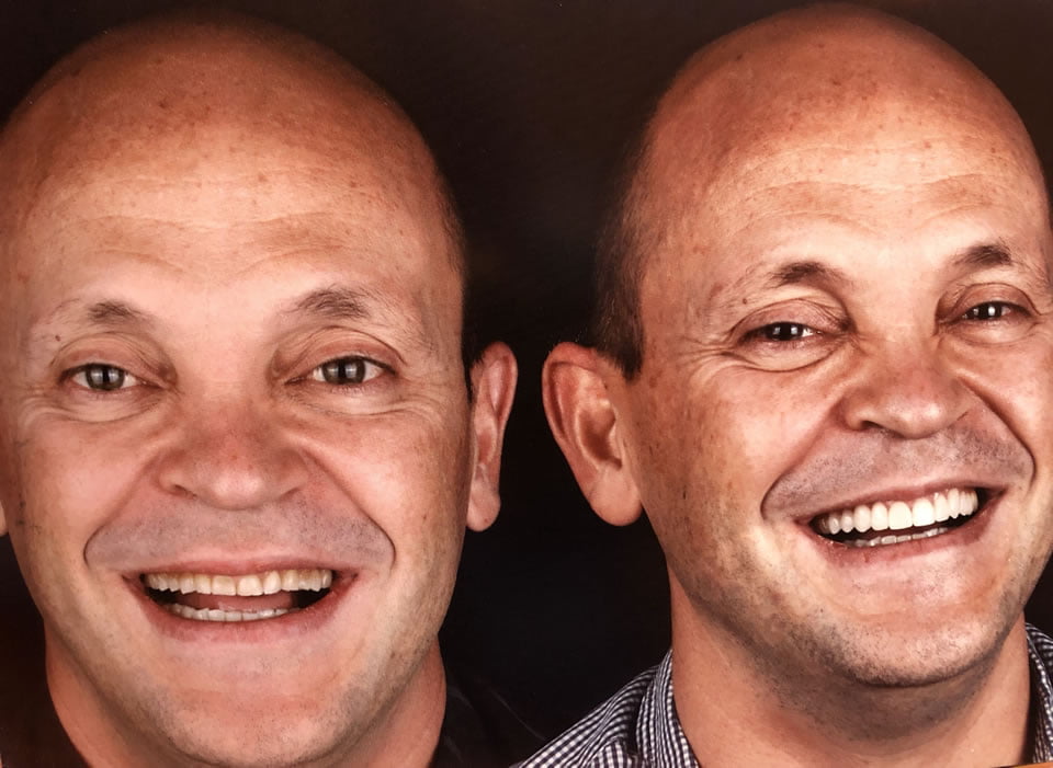 Carillas dentales | Dr. Manuel López de Calatayud