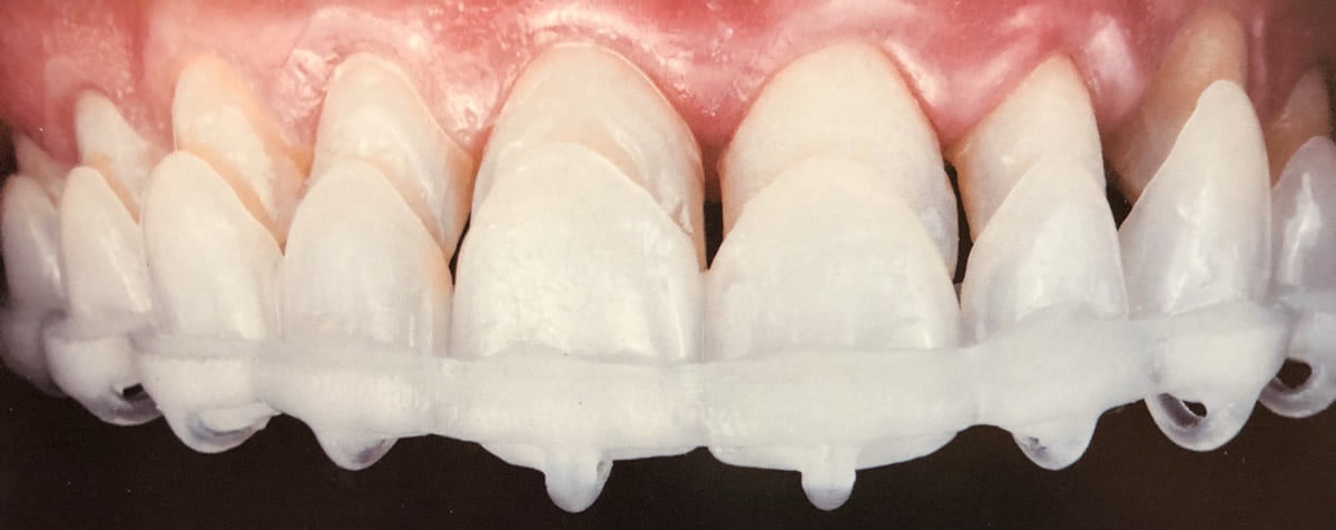 Carillas dentales | Dr. Manuel López de Calatayud