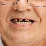 Dr. Manuel López de Calatayud - Blog - Tener todas las piezas dentales sí es importante