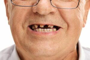 Dr. Manuel López de Calatayud - Blog - Tener todas las piezas dentales sí es importante
