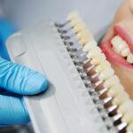 Clínica dental Dr. Manuel López de Caltayud - Blog - Blanqueamiento dental: Más allá de la moda