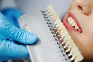 Clínica dental Dr. Manuel López de Caltayud - Blog - Blanqueamiento dental: Más allá de la moda