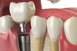 Dr. Manuel López de Calatayud - Blog - Todo lo que debes saber sobre los implantes de carga inmediata