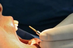 Dr. Manuel López de Calatayud -Blog - Implantología estratégica versus implantología convencional