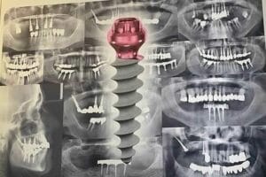 Dr. Manuel López de Calatayud - Blog - Implantes dentales Monoblock