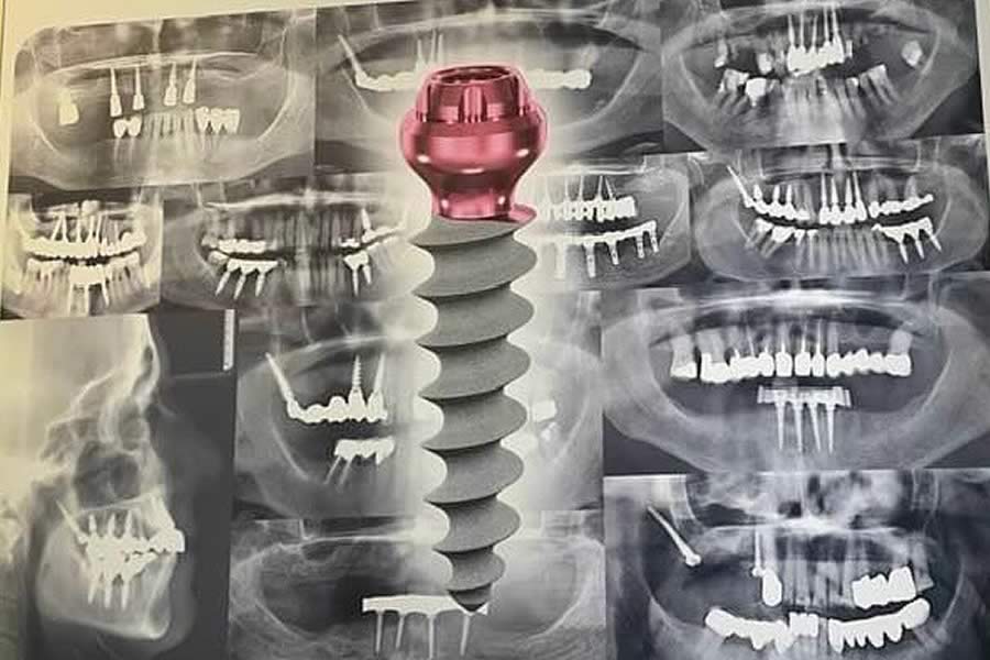Dr. Manuel López de Calatayud - Blog - Implantes dentales Monoblock